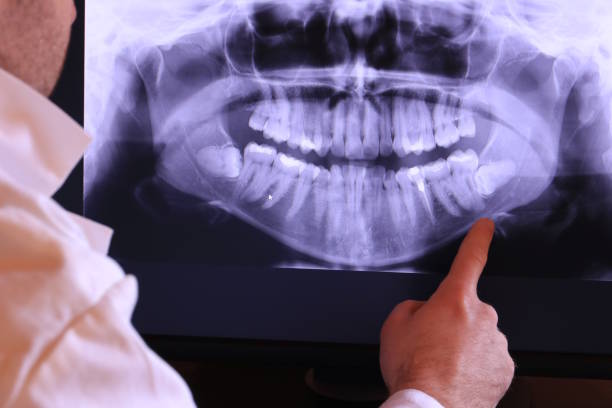 Best Emergency Wisdom Teeth Removal in Dover Base Housing, DE