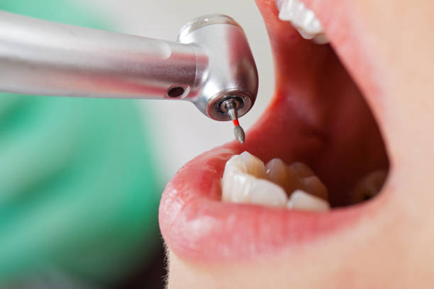 Best Emergency Tooth Extraction in Dover Base Housing, DE
